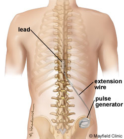 Sistemul de stimuare a maduvei spinarii