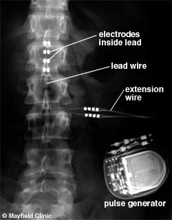 Radiografia maduvei spinarii