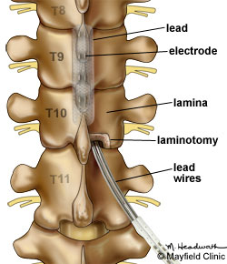 O laminotomie este efectuata in vertebra osoasa